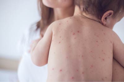 水痘引起的并发症要重视，理应接种水痘疫苗预防  
